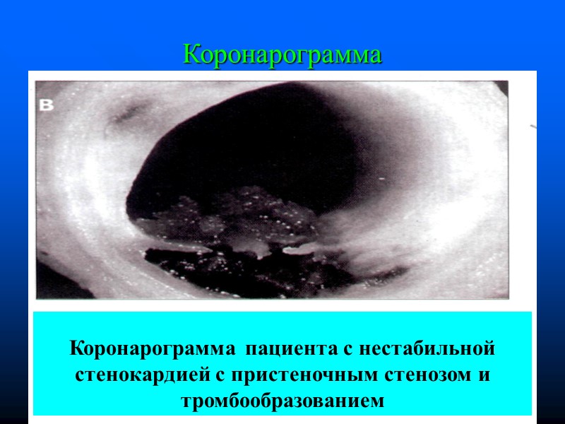 Коронарограмма Коронарограмма пациента с нестабильной стенокардией с пристеночным стенозом и тромбообразованием Коронарограмма Коронарограмма пациента с нестабильной стенокардией с пристеночным стенозом и тромбообразованием